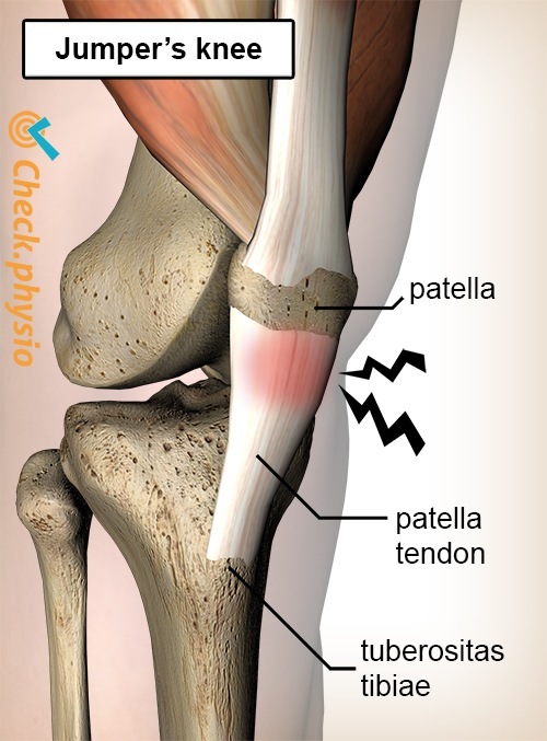 https://www.physiocheck.ca/images/artikelen/136/knee-jumpers-knee-pain-patella-tendon-tendinitis.jpg