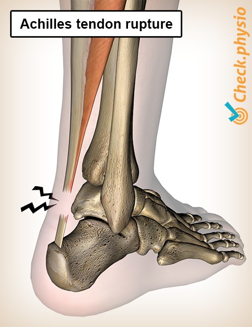 Recovery Time of Achilles Tendon Injury | MyMSK Clinic Manchester & Burnley