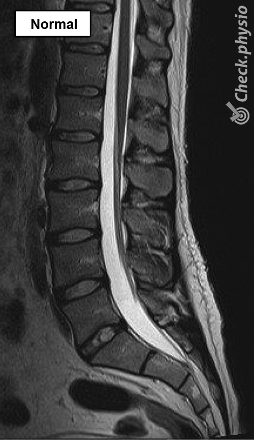 https://www.physiocheck.ca/images/artikelen/214/back-lumbar-spine-mri-normal.jpg