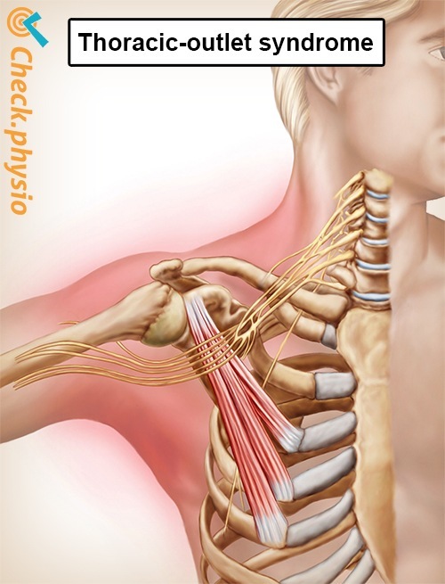 Thoracic outlet syndrome | Physio Check