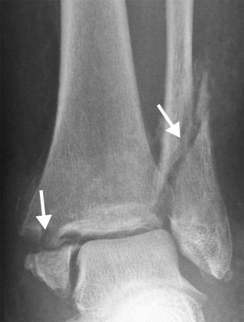 Ankle Fractures - Tyler, TX