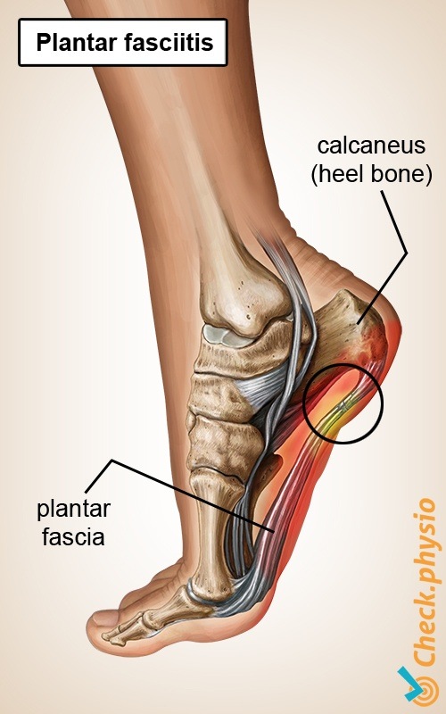 Is That a Heel Spur — or Plantar Fasciitis?: North Central Texas