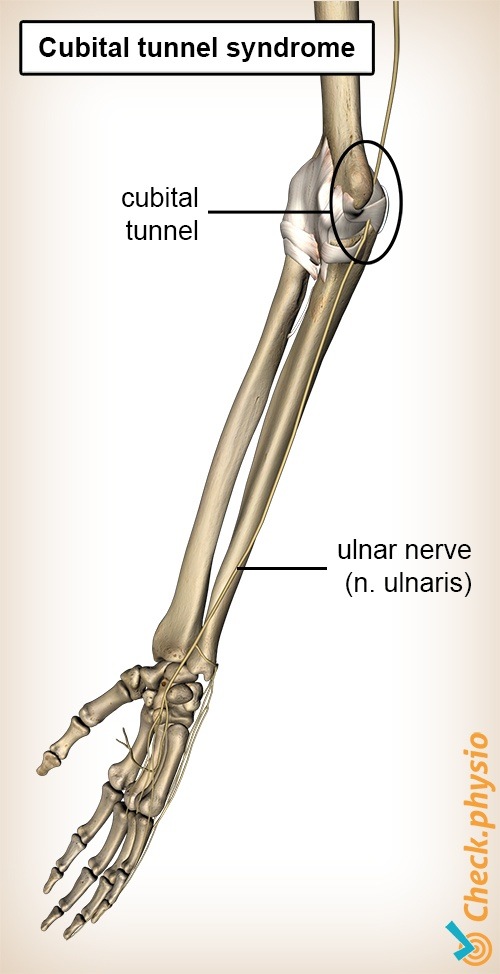 ULNAR NERVE INJURY ,CAUSES ,SYMPTOMS ,DIAGNOSIS AND TREATMENT. Cubital  tunnel syndrome. 