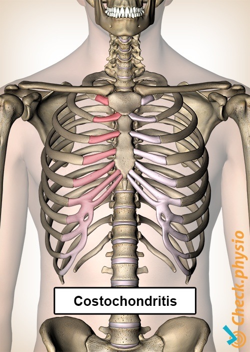 https://www.physiocheck.ca/images/artikelen/38/costochondritis-ribs-pain-chest-rib-cage-sternum.jpg