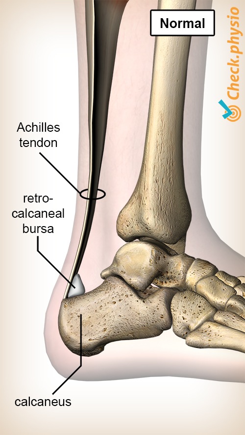 Heel (Retrocalcaneal and Calcaneal) Bursitis | Arthritis-health