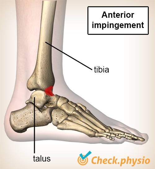 Medial ankle ligament injury