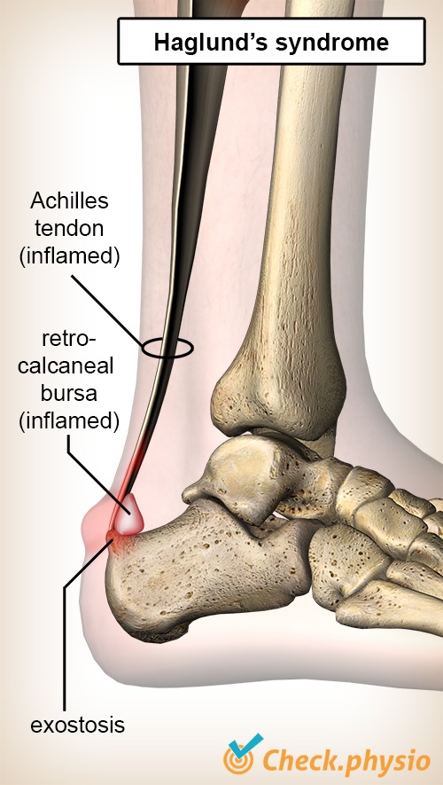 Foam roller Achilles tendon exercises